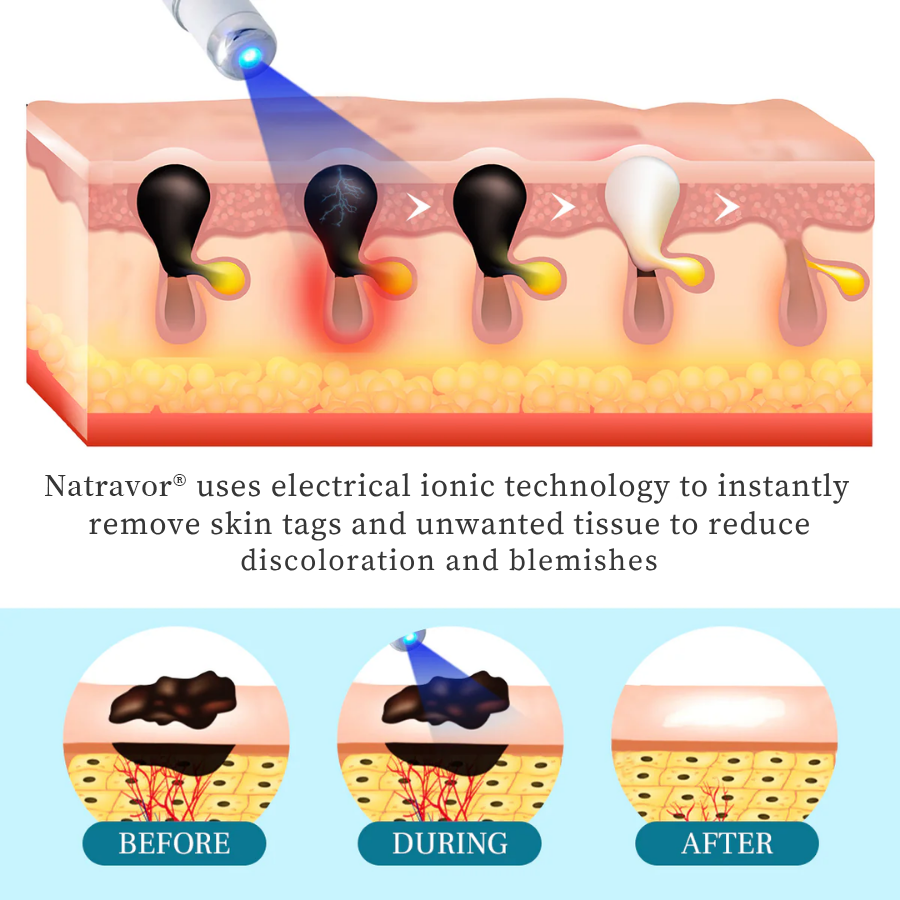 Natravor® LumeSkin Mole and Wart Removal Laser Pen