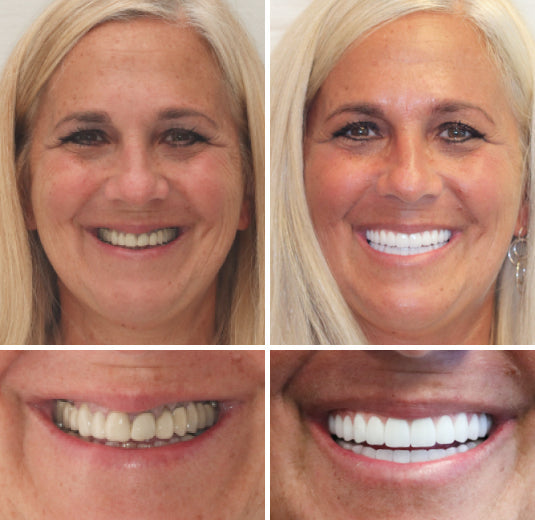 🦷Natravor™- Dentadura Premium（⏰Descuento por tiempo limitado, últimos 30 minutos.）