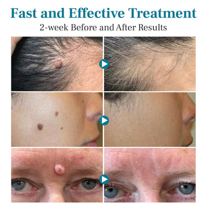 Natravor® LumeSkin Mole and Wart Removal Laser Pen